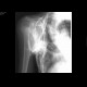 fibrodysplasia ossificans progressiva: X-ray - Plain radiograph